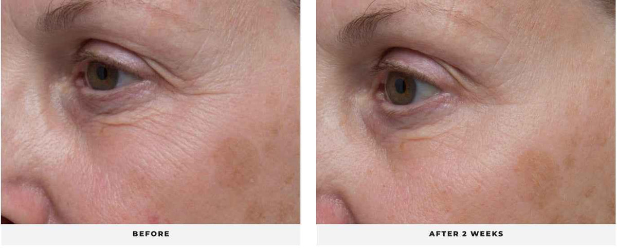 LIFT Eye Treatment