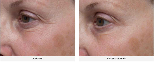 LIFT Eye Treatment