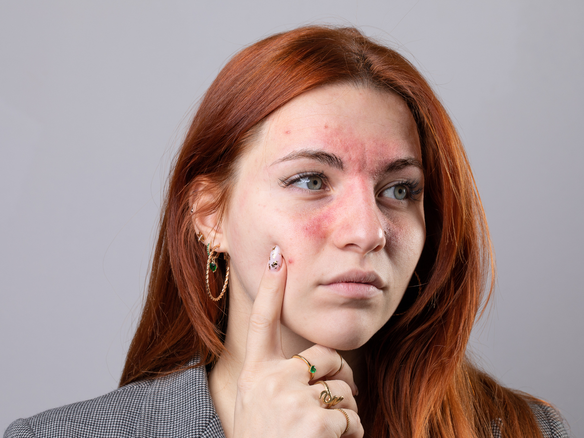 A close-up portrait of a young woman with red hair and visible facial acne, touching her cheek with her finger against a plain gray studio background.