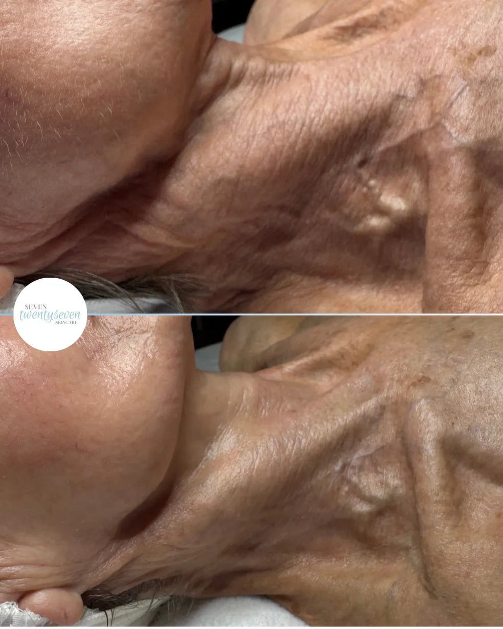 A close-up before-and-after style comparison of an older person's neck and cheek area, showing skin texture and wrinkles. A white circular logo reading 'Skin Transformation' appears on the left side.