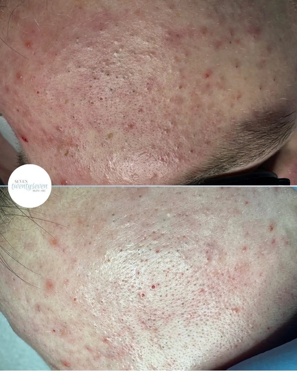 Before and after close-up comparison of a person's forehead showing acne and pore improvement. A circular 'Sevins Medplaster' logo is visible on the left side of the top panel.