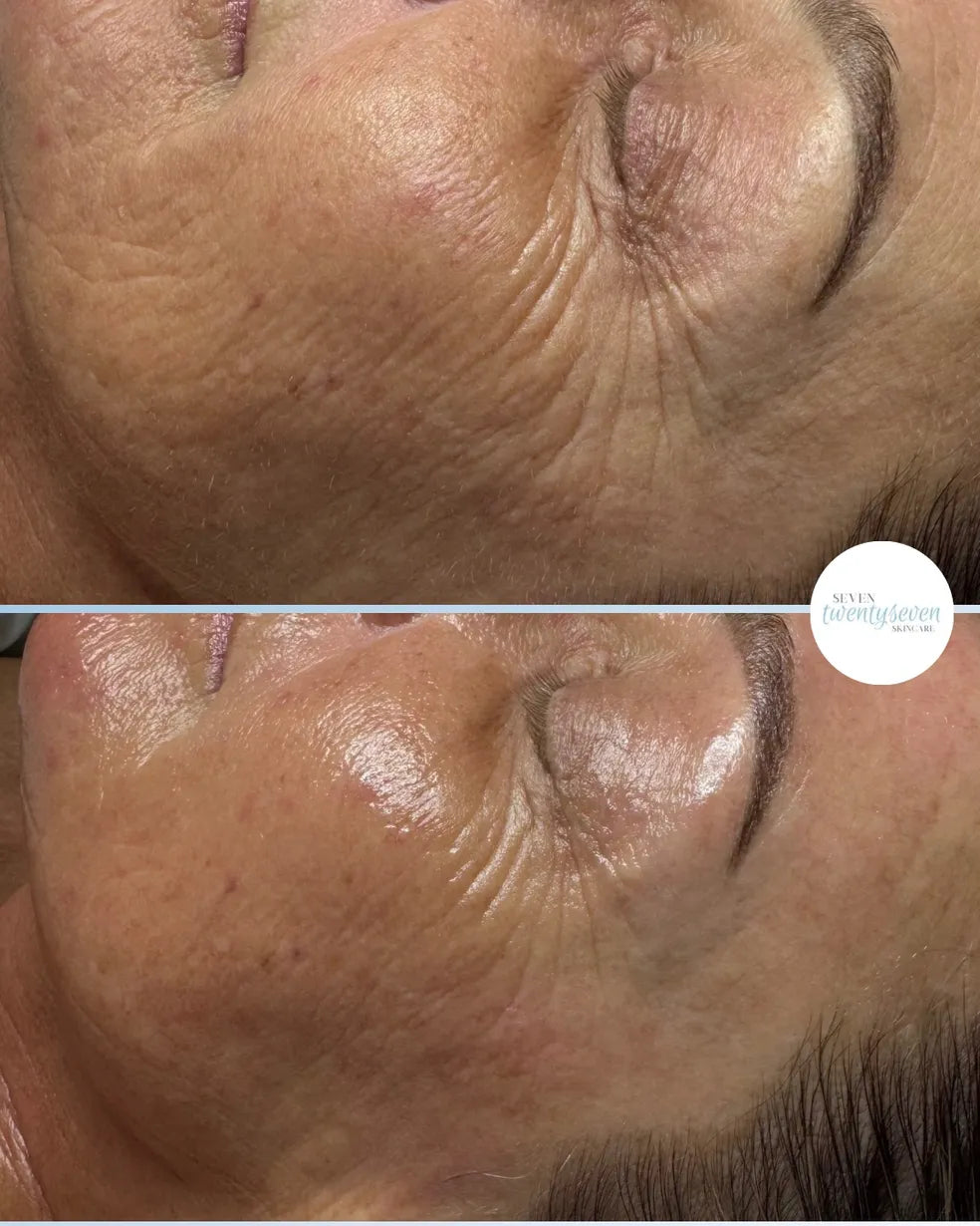 Before-and-after close-up comparison of a woman's cheek, eye area, and forehead showing skin texture and wrinkles, with a small circular 'NexGen Beauty' logo on the right.