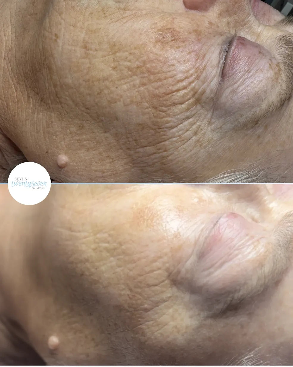 Before and after close-up comparison of a person's cheek and jawline skin, showing a visible reduction in wrinkles and texture in the bottom panel. A circular 'Skin Rejuvenation' logo watermark appears on the left.