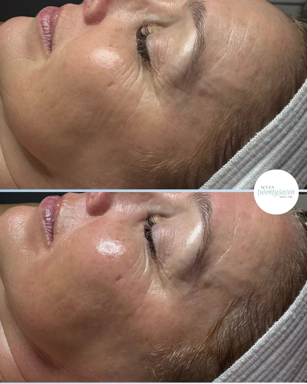 Before-and-after close-up comparison of a woman's face, showing visible skin texture and wrinkles in the top panel and smoother, more youthful skin in the bottom panel. A white headband is worn, and a circular logo for 'Mines (Montreal)' appears on the right side.
