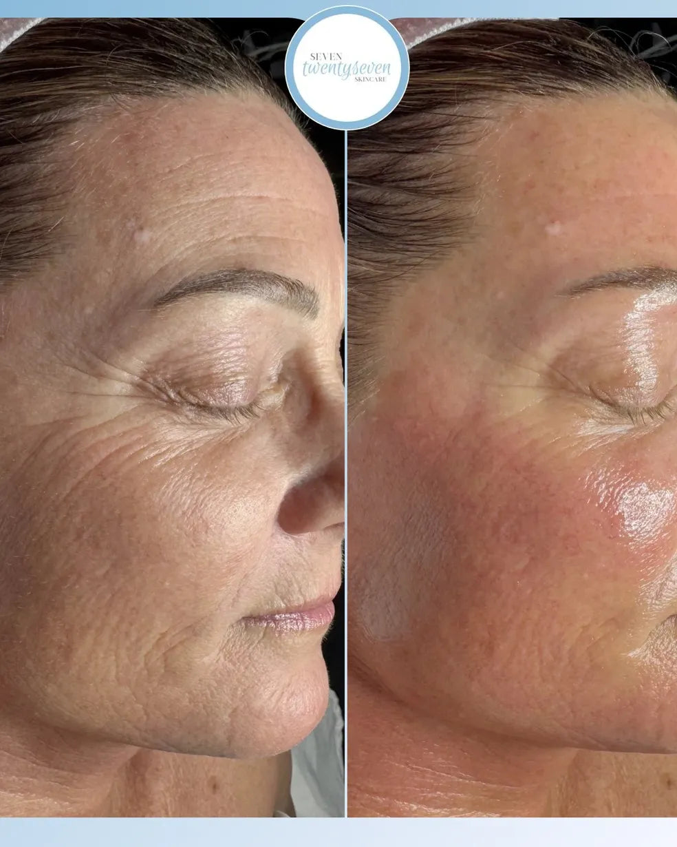 Before-and-after side-by-side comparison of a woman's face showing skin texture and wrinkle improvement, with a circular 'MAXX skin therapy' logo at the top.