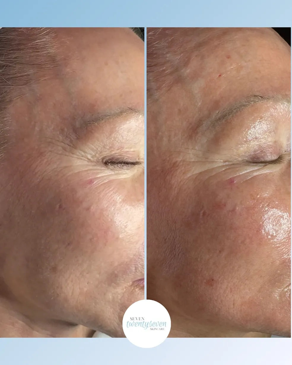Before and after close-up facial comparison of a person's cheek and eye area, showing skin texture improvement. A circular logo at the bottom reads 'SEVEN skincare clinic'.