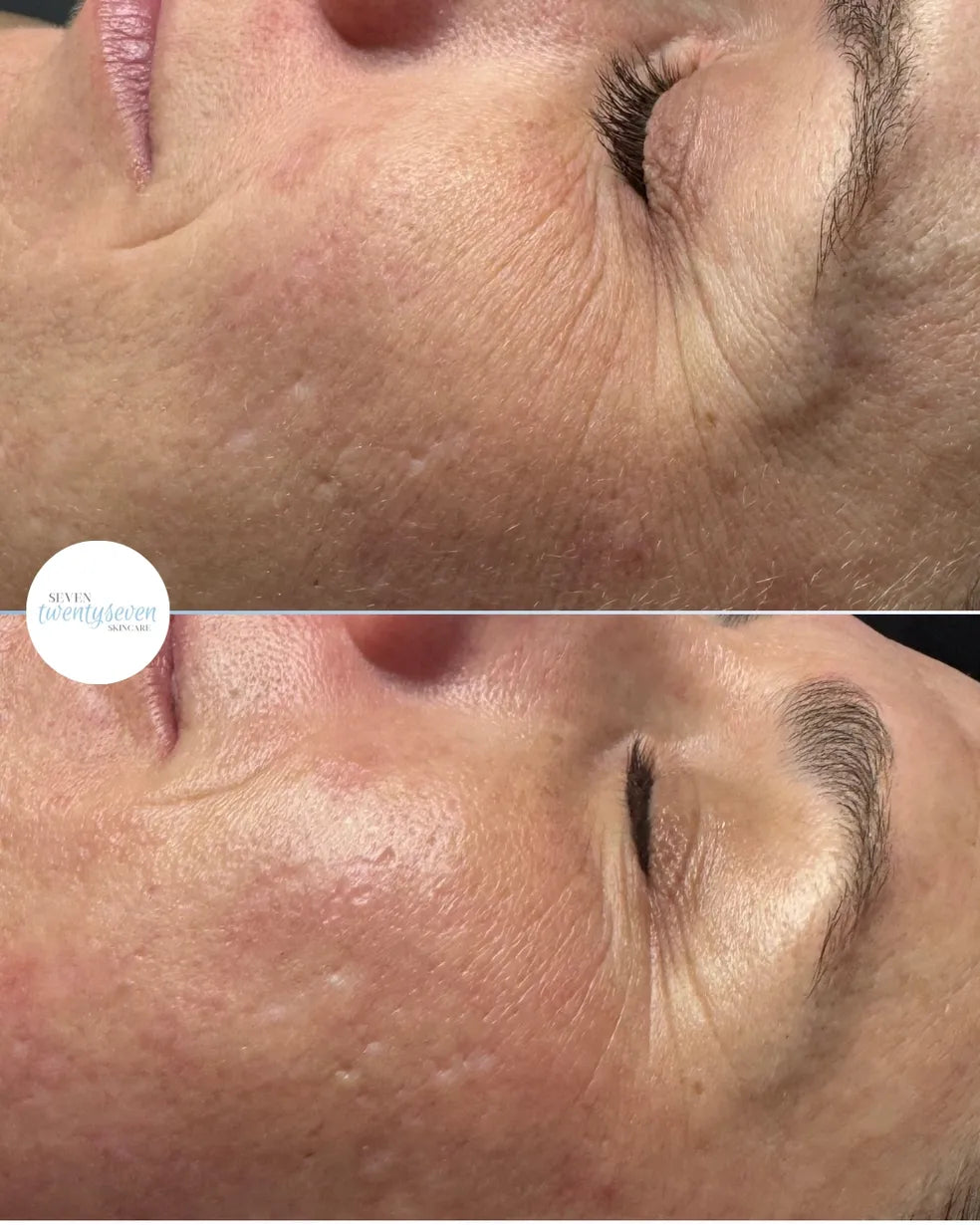 A before-and-after split comparison of a woman's cheek and eye area, showing skin texture and wrinkle improvement. The top panel shows more visible wrinkles and texture, while the bottom panel shows smoother, clearer skin.