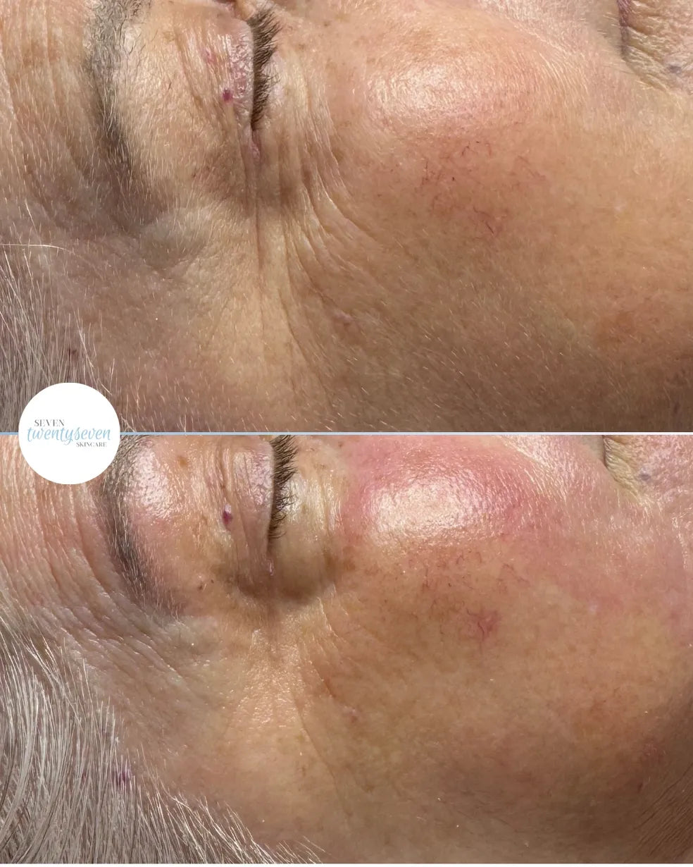 A close-up before-and-after comparison of an older woman's face, focusing on the forehead and eye area. The top image shows more visible skin wrinkles and creases, while the bottom image shows a smoother, more youthful appearance.