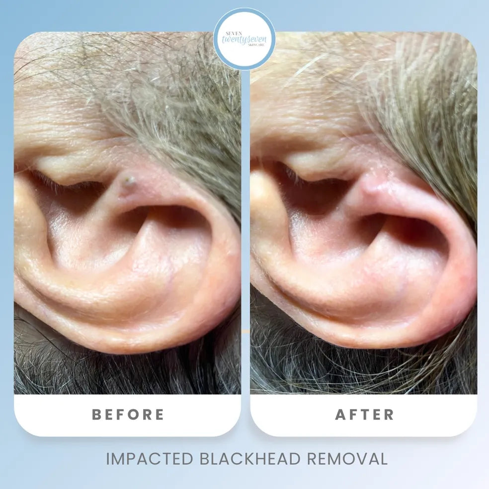 Before and after comparison of an impacted blackhead on an ear, showing the skin and ear before treatment on the left and after treatment on the right, with the text 'IMPACTED BLACKHEAD REMOVAL' at the bottom.