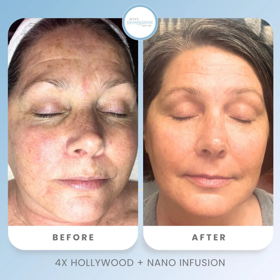 Before and after facial skin comparison of a woman, showing visible skin improvement. The image includes a circular logo at the top reading 'Texas Dermatology' and text at the bottom reading '4X HOLLYWOOD + NANO INFUSION'.