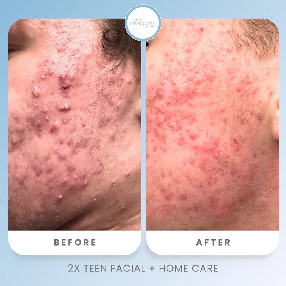 Before and after comparison of a person's cheek showing improvement in acne and redness, with the text '2X TEEN FACIAL + HOME CARE' and a circular 'Texas Dermatology' logo at the top.
