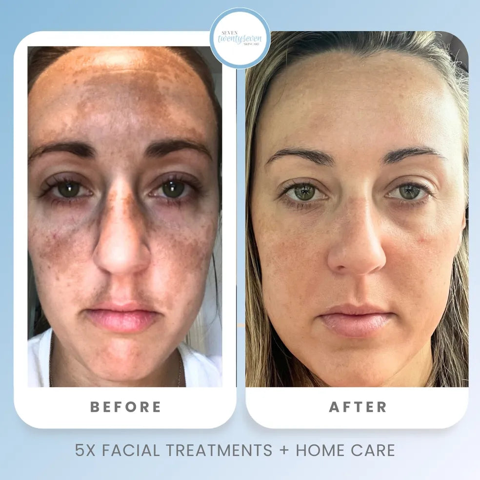 Before and after facial skin comparison of a woman, showing improvement in skin texture and appearance after 5x facial treatments + home care, with the Texas Beauty Place logo at the top.