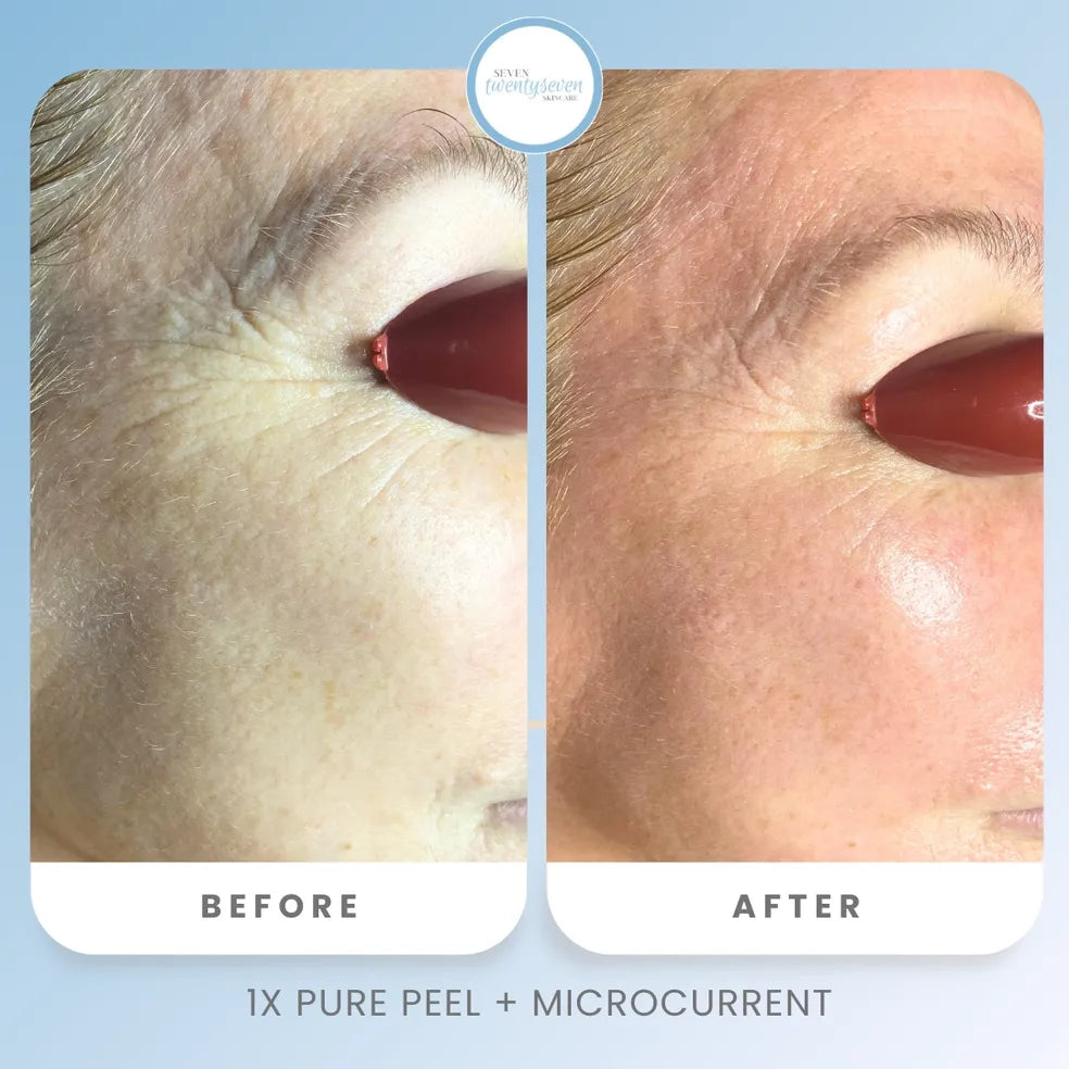 Before and after skin comparison showing the eye area of a person, with visible wrinkles and sun damage on the left labeled BEFORE, and smoother, brighter skin on the right labeled AFTER. A circular logo at the top reads Nexx Dentistry, and text at the bottom says 1X PURE PEEL + MICROCURRENT.