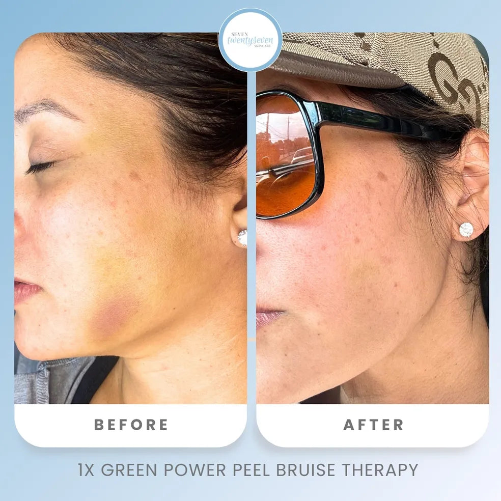 Before and after facial skin comparison of a woman's cheek and jawline, showing skin improvement after '1X Green Power Peel Bruise Therapy'. The left side is labeled 'BEFORE' and shows visible red bruising; the right side is labeled 'AFTER' and shows clearer skin.