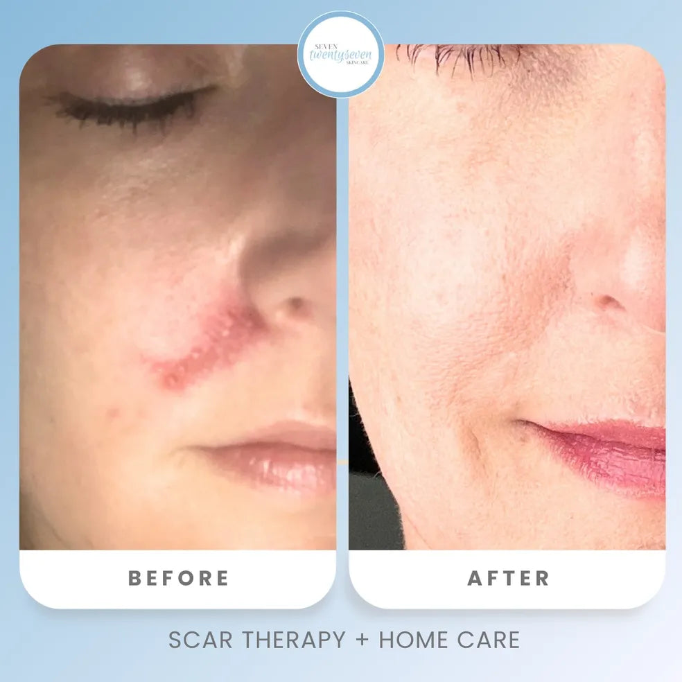 Before and after comparison of a scar on a person's cheek, with the left panel showing a raised red scar and the right panel showing a smoother, healed-looking area. The image includes the text 'BEFORE', 'AFTER', and 'SCAR THERAPY + HOME CARE', plus a circular 'Next Dentistry' logo at the top.