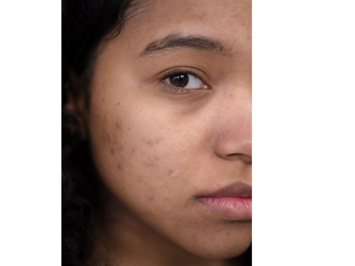 Close-up of a person's face showing skin texture and blemishes, with dark hair on the left and a plain light gray background on the right.